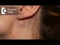 What causes swelling of lymph node near the ear in a young female - Dr Satish Babu K