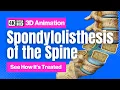 Spondylolisthesis of the Spine - See How It s Treated
