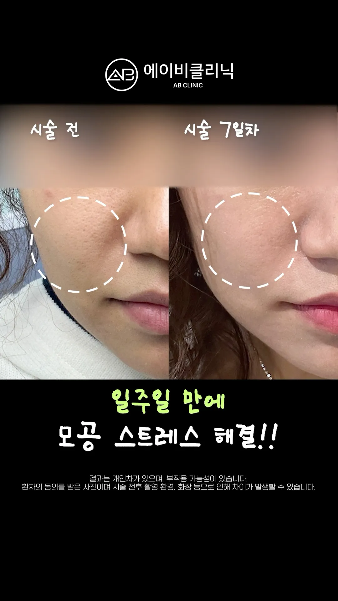 넓은 모공, 제발 포텐자하세요🔥