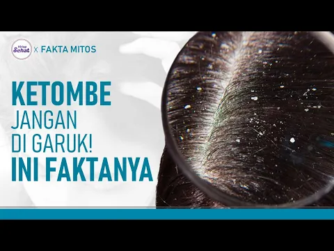 Jangan Dibiarkan! Ini Dampak Ketombe Pada Kulit Kepala