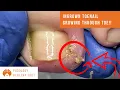Download Lagu Ingrown toenail GROWING THROUGH TOE! ***in a Relaxing ASMR***