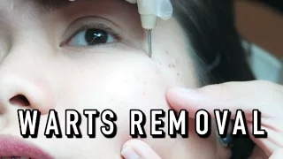 Download WARTS REMOVAL (LETS FACE IT) | VLOG MP3