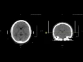 Unremarkable Non-Contrast CT Axial Scan - Example 3