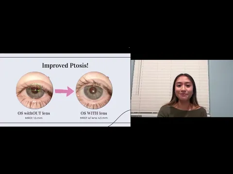 Scleral Lenses for Congenital Ptosis: A Non-Surgical Solution to Improve Lid Position & Dry Eye