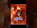 Colonoscopy Dr Paulien Moyaert