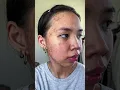 Download Lagu acne journey 🫶🥺 #shorts #acne #acnejourney #acneproneskin #acnetreatment