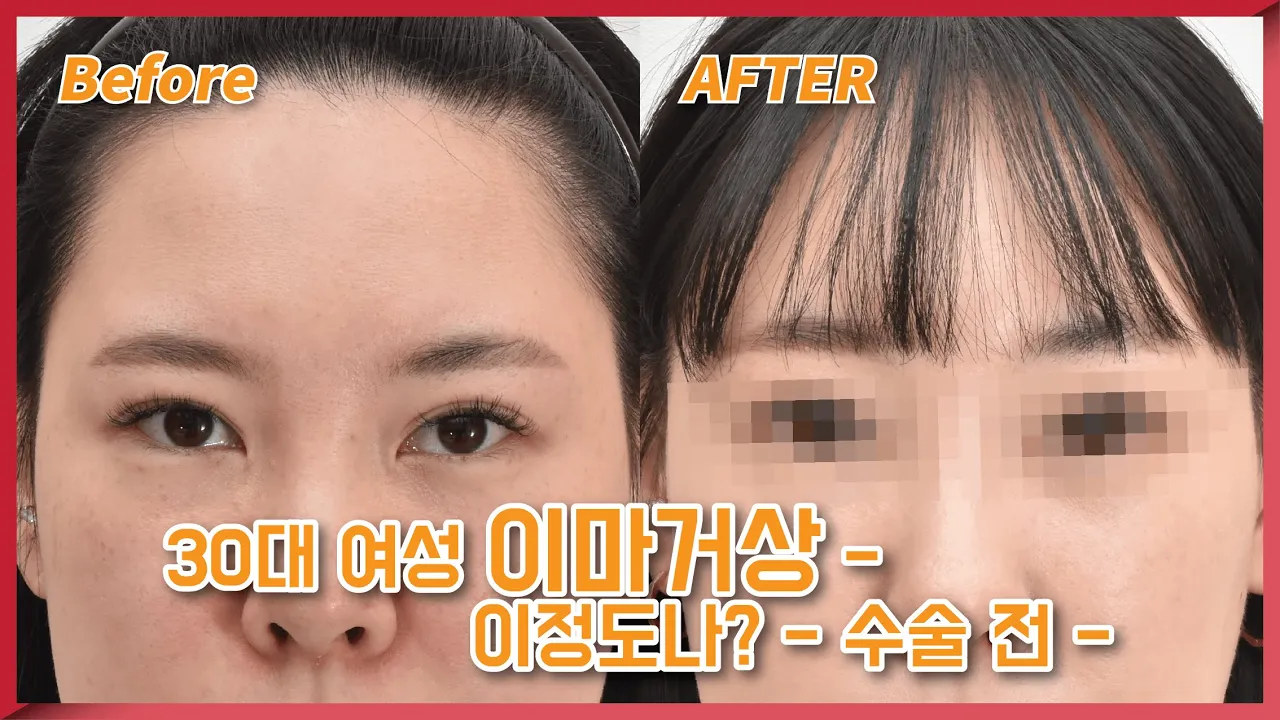 30대 여성 이마거상, 이정도나? - 수술 전