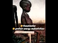 Download Lagu Kwashiorkor- Severe Deficiency of Protein #mbbs #next