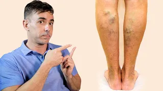 COMO ELIMINAR VARIZES? | DR DAYAN SIEBRA