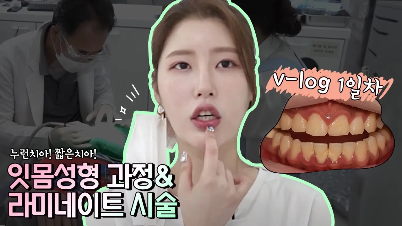 잇몸성형과 라미네이트시술까지 1탄 [VLOG]