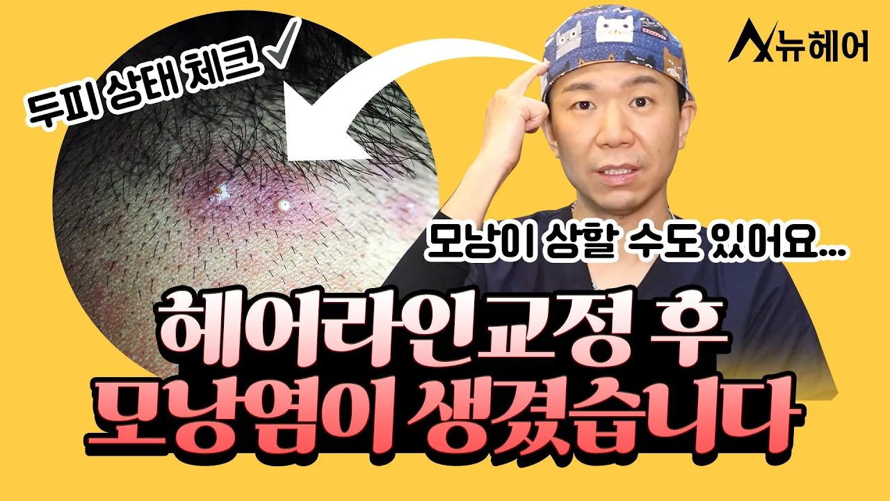 헤어라인 수술 후 생긴 모낭염, 수술 결과에 문제없을까? | 뉴헤어