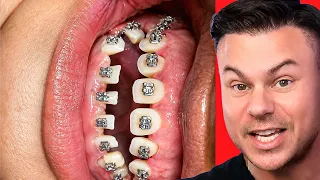 They did WHAT to their teeth??
