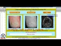 Fingernail Disease Detection Using Machine Learning Algorithm Image Processing Matlab Project Code