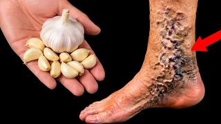 UNGLAUBLICH❗️ Knoblauch hilft bei Krampfadern, Gelenken, Schwellungen und unterstützt die Nieren!