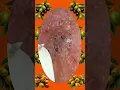 Blackheads Removal Acne Treatment and Very Satisfying Satisfying Pimple pop