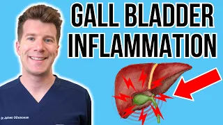 Doctor explains Acute Cholecystitis Gall bladder inflammation Causes symptoms treatment more