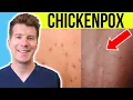 Doctor explains CHICKENPOX Causes Stages Symptoms Treatment PLUS PHOTOS