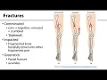 Download Lagu MSK Skeletal System Basics - Fractures