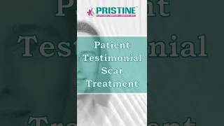 Patient Testimonial Scar Revision Treatment for Old Left Cheek Puckered Scar Scar Revision Surgery