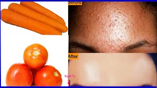 عصير الطماطم مع الجزر للتخلص من الحبوب والبقع الداكنة نهائياً وبطريقة طبيعية / حل سريع لحبوب الوجه
