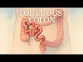 GI Focus Tortuous Colon drlizcruz