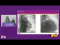 Download Lagu Cardiogenic shock and high-risk interventions with percutaneous mechanical circulatory support