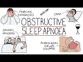 Obstructive Sleep Apnoea