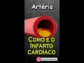 Download Lagu Como é o infarto do coração #shorts