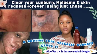 ALOE VERA TRILUMA PALM OIL REMEDY SAY GOODBYE TO SUNBURN MELASMA REDNESS DARKSPOT PERMANENTLY