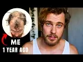 Download Lagu Preventing Balding: What I Did Before It Was Too Late.