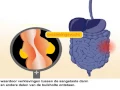 Download Lagu Ziekte van Crohn - Symptomen en behandeling van de ziekte van Crohn