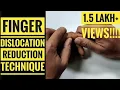 Finger Dislocation Reduction Technique