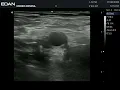 con maniobra compresiva de la vena safena magna izquierda
