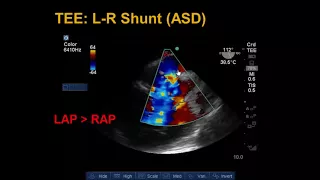 Transesophageal Echocardiography Shunts and Bubble Study