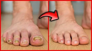 5 remedios caseros para quitar los hongos de las uñas de manos y pies  muy fácil | Gio de la Rosa