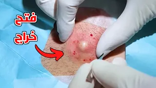 شاهد الفرق بين الحباية والدمل والخراج The Difference Between A Pimple A Boil And An Abscess 