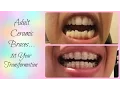 Download Adult Braces Transformation | Time Lapse + Extractions Before and After mp4 3gp mp3 videos - waplic