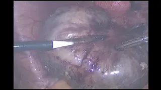 a case of acute abdominal pain