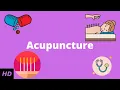 Acupuncture What You Need to Know
