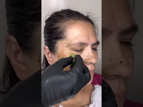 mi mama a sus 55 años logro evitar los parpados caidos