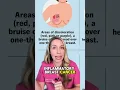FIRST Signs of Breast Cancer