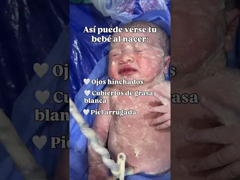 Así puede verse tu recién nacido en el primer momento.. Todo es normal ❤️