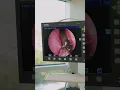 Download Lagu WHAT IS THAT?! #ent #entsurgery #hearingloss #nasalcongestion #sinusinfection #sinusitis #nose