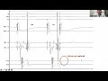 Lesson 8 Incremental pacing atrial stimulation for every EP study