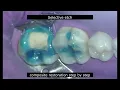 Direct pulp capping with MTA | Do watch before getting a root canal treatment| Tooth saved from RCT|