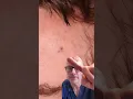 Early Stage Melanoma A Life-Saving Detection