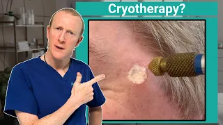 Freeze It or Cut It Out How Doctors Decide Cryotherapy Explained