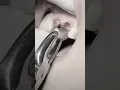 Extraction of remaining roots
