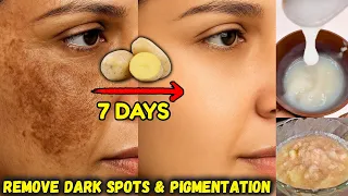 Potato to Remove Pigmentation & Dark Spots in Just 7 Days | Potato Cream for Clear Bright Skin