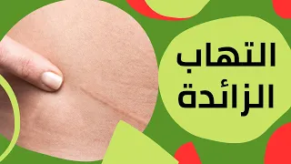 أعراض التهاب الزائدة الدودية والفرق بينها وبين وجع القولون دندنها